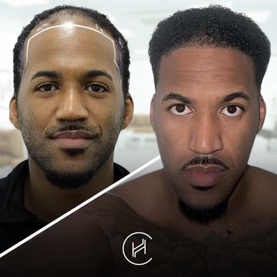 Hår i fokus: så tar du ärliga före/efter-bilder – lärdomar från Nordic Hair Clinic